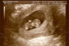 Ultrasound pic at 11 weeks!