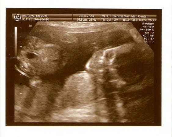 20 weeks ultrasound!!