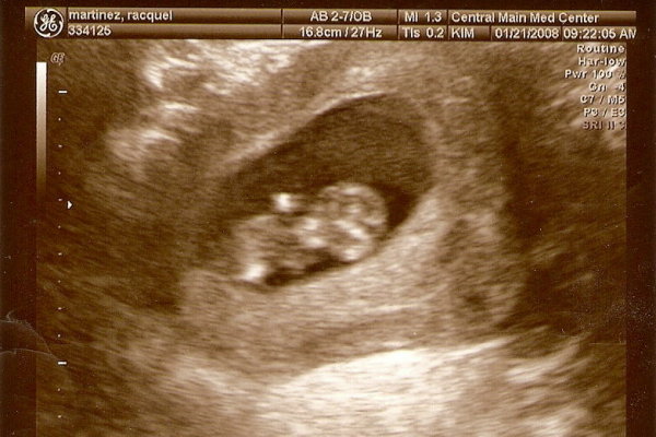 Ultrasound pic at 11 weeks!